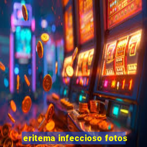 eritema infeccioso fotos